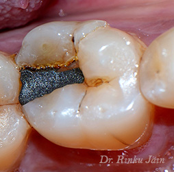 Tooth fracture silver filling