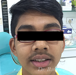 Orthodontic Treatment After