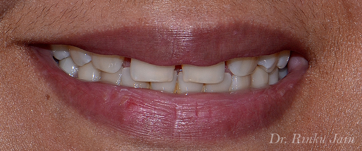 Gaps in teeth