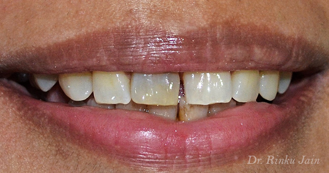 Instant Tooth Whitening Before