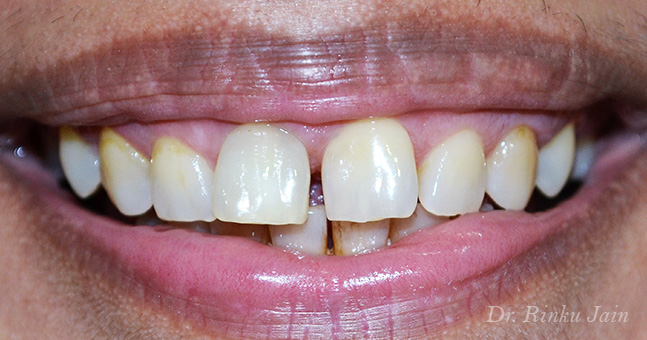 Instant Tooth Whitening After