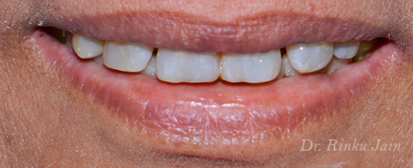 Restored teeth with biom