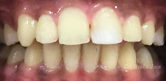 Orthodontic Treatment After