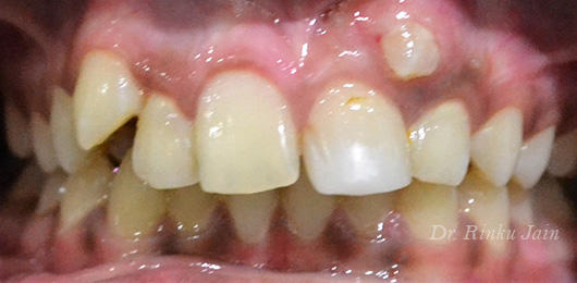 Orthodontic Treatment Before