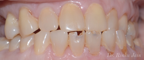 Cavities and broken teeth before