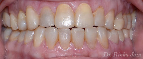 Full mouth restoration after